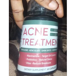 Treatment (Acne Treatment) X1